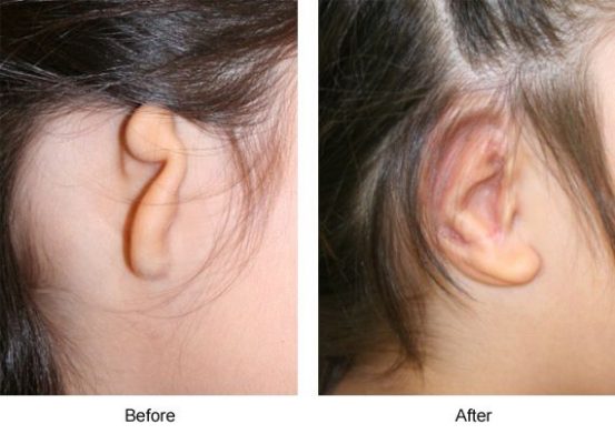 microtia - deformidade nas orelhas