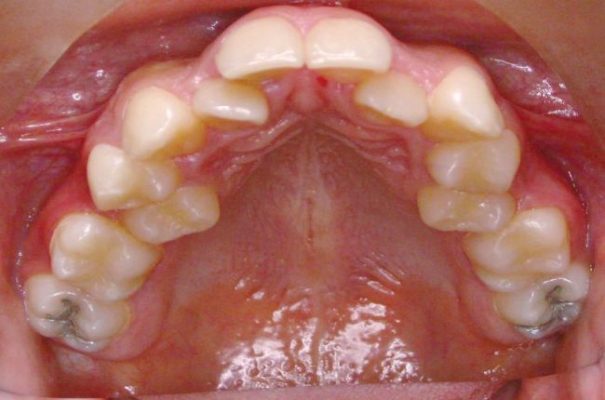 Atresia maxilar